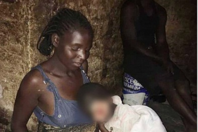 Lý giải 'bệnh lạ' do di truyền cứ ra ngoài nắng là bị 'tan chảy'