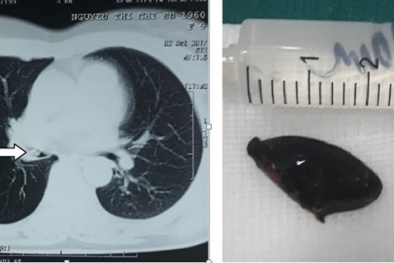 Ngã ngửa với hạt hồng xiêm mắc trong phế quản gây ho suốt 3 năm 