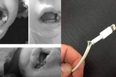 Bé gái 19 tháng tuổi bỏng nặng vì thói quen dùng điện thoại hầu như gia đình nào cũng mắc phải