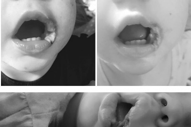 Bé 19 tháng tuổi suýt mất môi vì ngậm sạc điện thoại