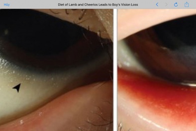 Suýt mù vì ăn kiêng khắc nghiệt và hàng loạt bệnh nguy hiểm 'tìm đến'