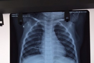 Nhiễm trùng, thủng tim vì trẻ ngã trúng vào kim khâu mẹ đánh rơi không biết