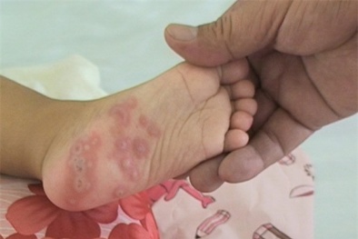 Khuyến cáo: Bệnh tay chân miệng đang 'tấn công' trẻ em không ngừng