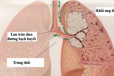 Thuốc lá: 'Thủ phạm' khiến 17.000 người tử vong mỗi năm tại Việt Nam