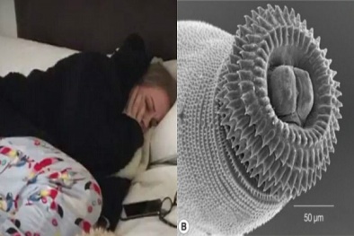 Nhiễm ký sinh trùng gây bệnh giun đầu gai nguy hiểm vì thói quen ăn uống