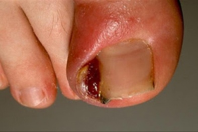 Nhiễm trùng vì làm Nail tại spa, chị em 'chạy mất dép'