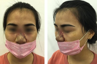 Cẩn thận với dịch vụ phẫu thuật thẩm mỹ của Spa 'vườn'