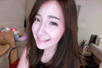 Niềng răng đừng chủ quan với bệnh loét áp-tơ miệng