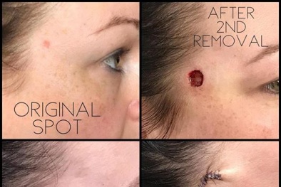 Cảnh báo: Nốt đỏ tưởng như mụn này thực chất lại là dấu hiệu của ung thư da