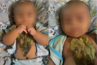 Dùng lá trầu không đắp lên ngực con để thông đờm, chuyên gia cảnh báo chỉ là lời đồn