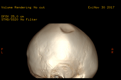 Quảng Ninh: Phẫu thuật cứu sống bệnh nhi 3 tuổi do chấn thương sọ não