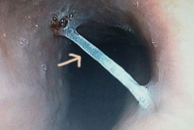 Viêm nhiễm nặng trong họng vì tự dùng kháng sinh khi hóc xương cá