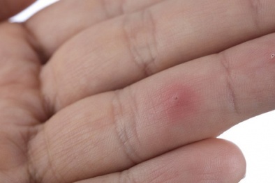 Chỉ một mảnh dằm đâm bạn cũng có thể bị hoại tử thịt nếu không biết điều này