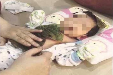 Bé 6 tháng tuổi bị bỏng sâu nhiễm trùng vì đắp lá trầu không trị khò khè