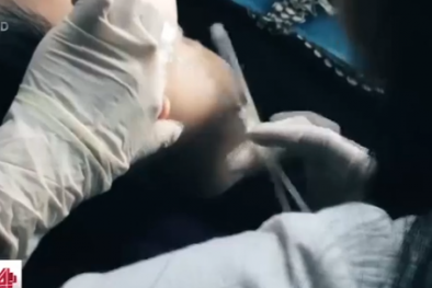 Nguy hiểm từ chất làm đầy trong phẫu thuật thẩm mỹ