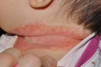  Mẹ Việt dừng ngay việc dùng phấn rôm trị hăm cho trẻ vì những lý do đáng sợ