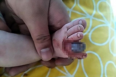 Chỉ vì sợi tóc rụng trẻ có thể bị cắt lìa tay, chân cha mẹ chớ coi thường