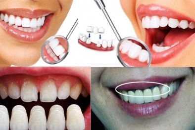  Ẩn họa từ bọc răng sứ kém chất lượng