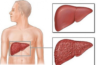 Những loại thuốc uống gây tổn hại gan trầm trọng cần biết để tránh