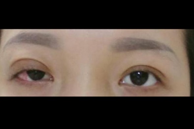 Cô gái vĩnh viễn không thể nhắm mắt sau khi cắt mí làm đẹp