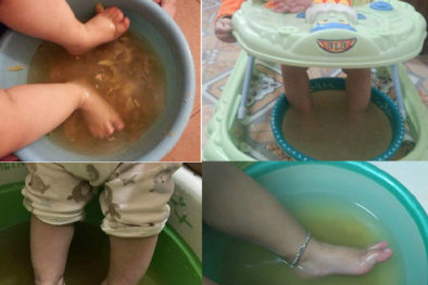 Con phải cấp cứu khẩn vì mẹ quá tin vào bài thuốc đắp lá dân gian chữa bệnh