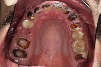 'Thối' hết cả hàm răng vì uống 'quá đà' loại nước phổ biến này