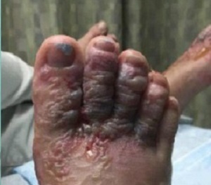 Đi chân trần trên bãi biển và kết cục đau đớn đến không tưởng