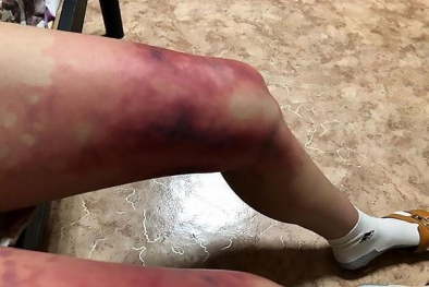 Diện váy ngắn trong thời tiết âm 40 độ, cô gái suýt mất đôi chân