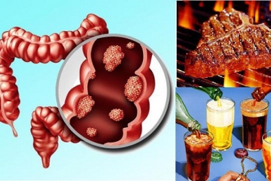Muốn không bị ung thư trực tràng hãy tránh xa những thực phẩm này