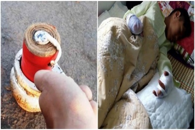 Mất cả bàn tay, vỡ bụng vì do pháo nổ