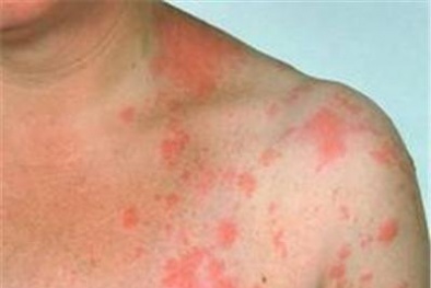 Tìm thấy vi khuẩn có thể đánh bại căn bệnh ung thư