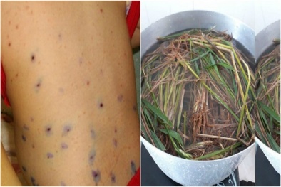 Chữa thủy đậu bằng cách tắm nước gốc rạ coi chừng 'Thần chết' đoạt mạng
