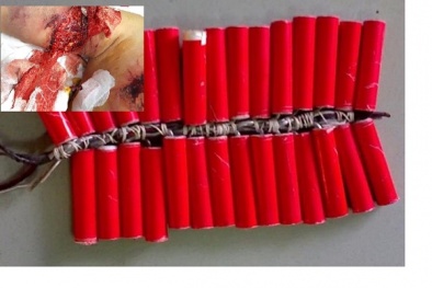 Bị pháo nổ văng trúng người, bé gái 13 tuổi nát tay, dập phổi