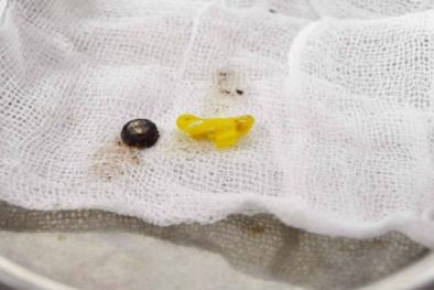 Phát hiện pin điện tử và dây thun trong mũi bé trai 32 tháng tuổi