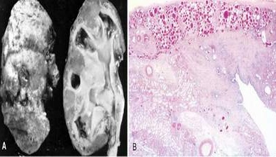 Cảnh báo: Trẻ em dễ mắc viêm cầu thận cấp sau khi bị viêm họng, viêm da
