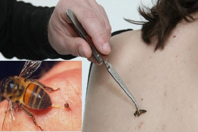 Hi hữu: Người phụ nữ 55 tuổi mất mạng vì châm cứu bằng cách cho ong đốt