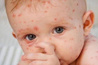 Top 5 căn bệnh nguy hiểm ‘chết người’ trẻ thường mắc phải vào mùa hè 