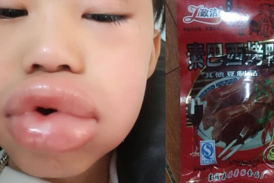 Ăn kẹo ở cổng trường học bé trai 6 tuổi sưng ‘vều’ môi