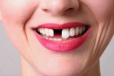 Ham rẻ làm răng sứ không đảm bảo chất lượng cẩn thận hỏng cả hàm răng