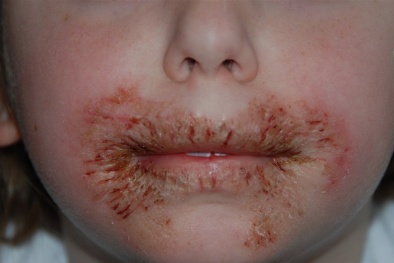 Khăn ướt có thể gây hàng loạt bệnh lý khó chịu 