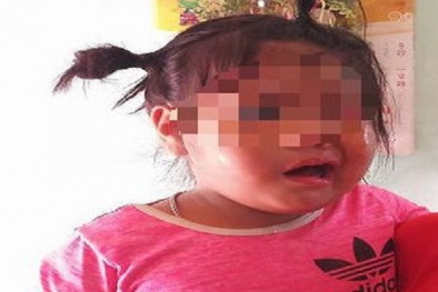 Cô giáo mầm non bị tố đánh bé 3 tuổi liệt dây thần kinh, méo mồm