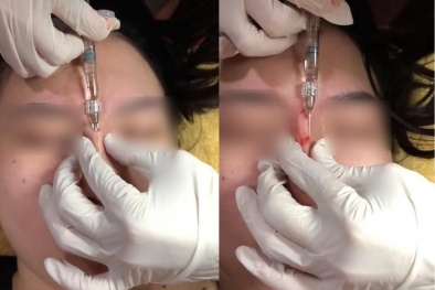 Tiêm filler giá rẻ làm đẹp: 'Lành thành què' trong tích tắc
