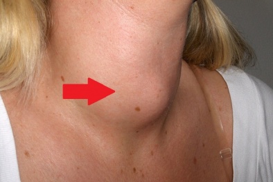 Người Việt ăn rất mặn nhưng lại thiếu i-ốt trầm trọng dễ mắc nhiều bệnh