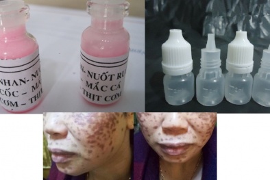 Trị nám, tàn nhang bằng axit: Xu hướng làm đẹp nguy hiểm