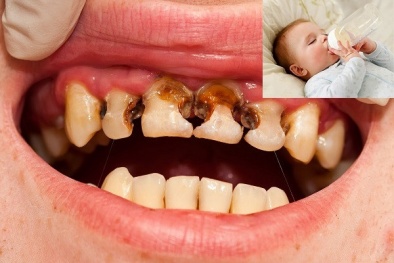 Cảnh báo hậu quả không ngờ khi trẻ bú bình, ngậm ti giả 