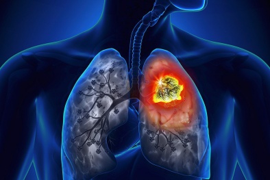 Ung thư phổi: 2 dấu hiệu nhận biết sớm nhất nhiều người hay bỏ qua