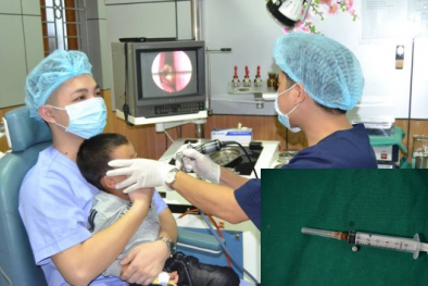 Bé trai bị mắc kẹt viên bi nhựa vào mũi- cảnh báo sâu sắc cho cha mẹ