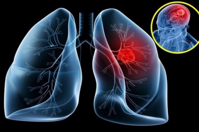 Ung thư phổi: 7 nguyên nhân gây bệnh ít người ngờ tới