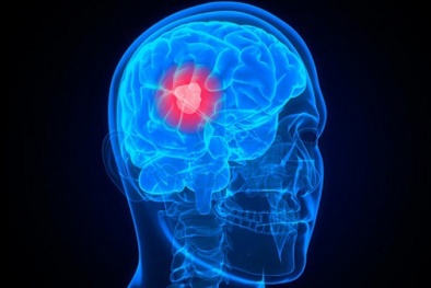 Ung thư não: 8 dấu hiệu nhận biết sớm nhất không thể bỏ qua