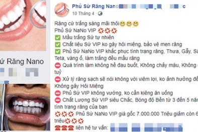 Dễ mất răng vì tin vào ‘công nghệ’ phủ sứ trắng răng nano
